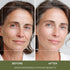 Advanced K-Beauty Microneedle Combo Mask